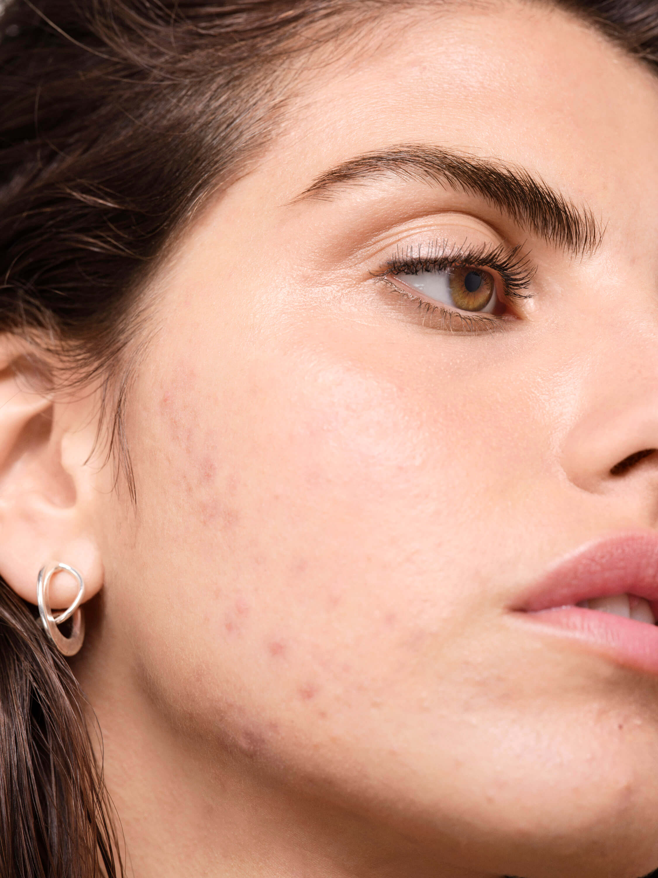 Existe-t-il-un-lien-entre-les-produits-laitiers-et-l'acné