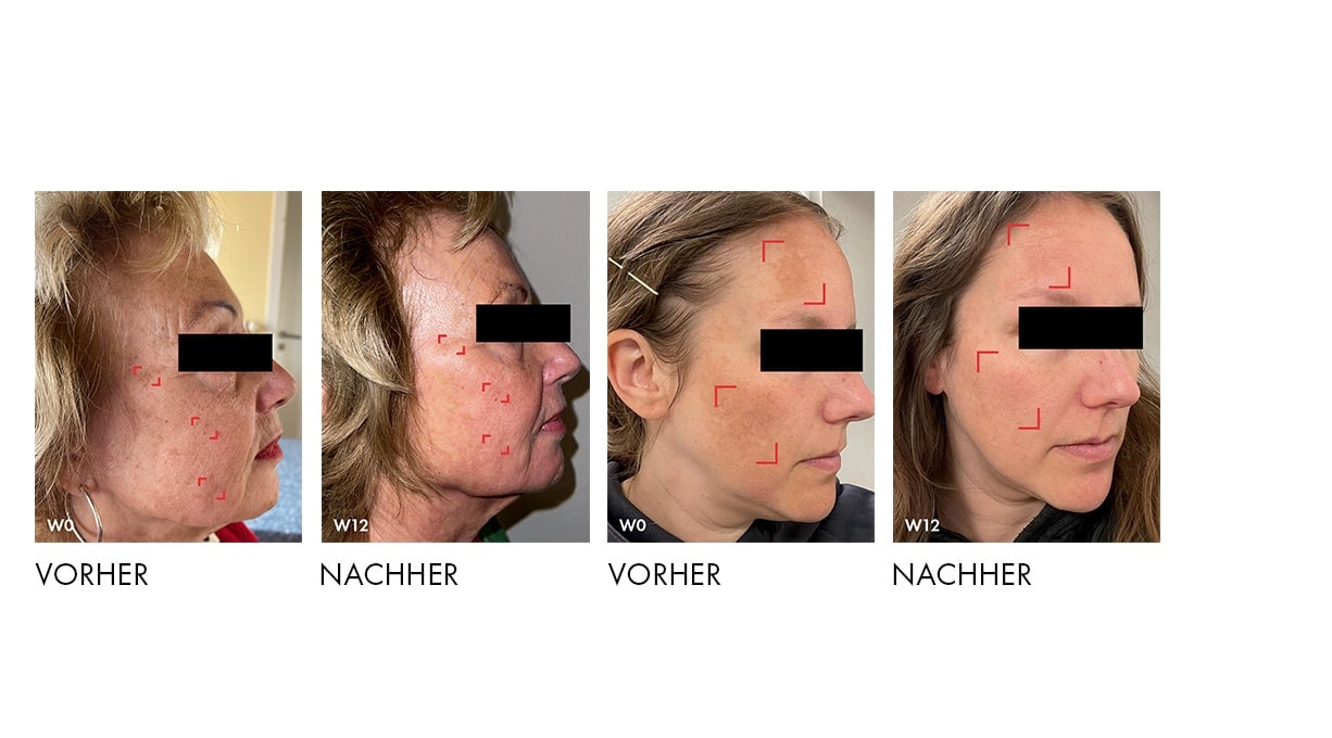 Vorher-Nachher-Bilder dokumentieren sichtbare Verbesserung der Hautstruktur nach zwölf Wochen