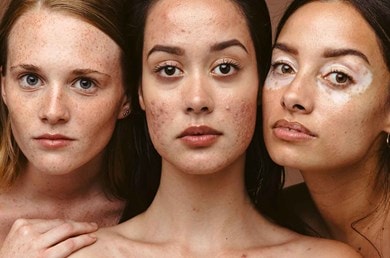 Drei junge Frauen mit Mischhaut und Akne