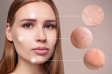 Gesicht einer jungen Frau mit Fokus auf verschiedene Hautprobleme wie trockene Stellen, Unreinheiten und Rötungen