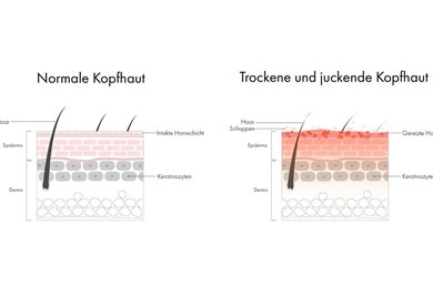 Infografik mit einer schematischen Abbildung der Hautschichten bei normaler Kopfhaut und einer Abbildung bei trockener, juckender Kopfhaut