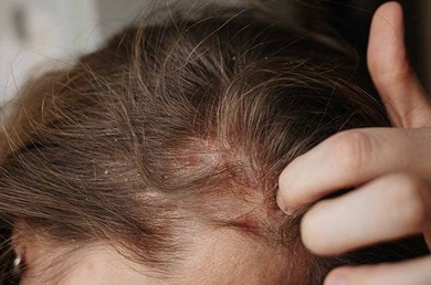 Frau kratzt an einem geröteten, schuppigen Bereich ihrer juckenden Kopfhaut