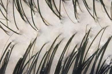 Nahaufnahme der Kopfhaut mit dunklen Haaren