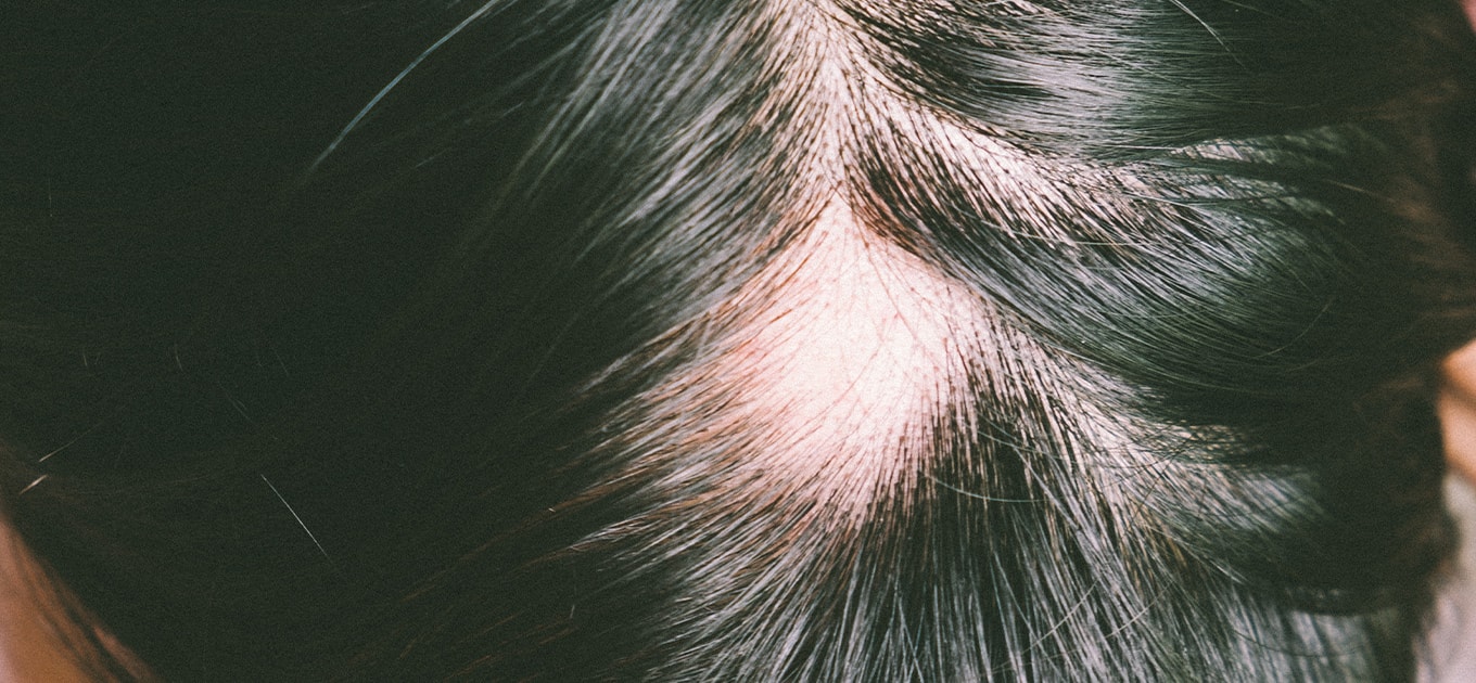 Nahaufnahme einer Kopfhaut mit kreisrundem Haarausfall am Scheitel