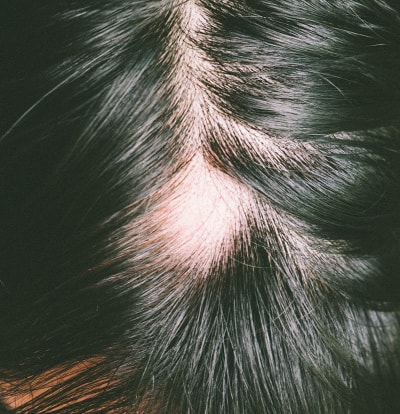 Nahaufnahme einer Kopfhaut mit kreisrundem Haarausfall am Scheitel