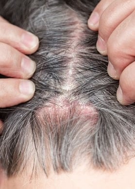 Person von hinten, die ihre Kopfhaut mit Psoriasis offenlegt