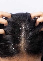 Kopf einer Person von oben mit dunklen Haaren und grossen Schuppen