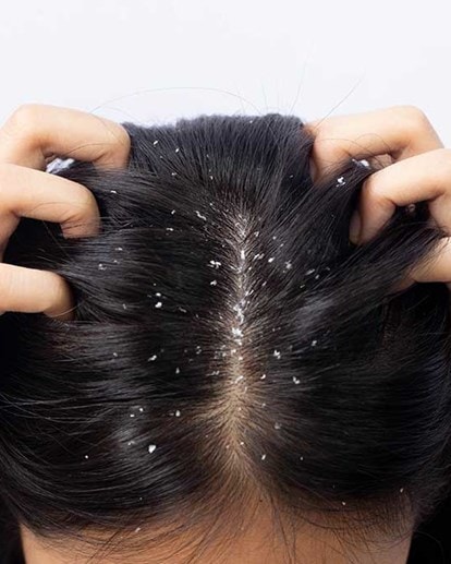 Kopf einer Person von oben mit dunklen Haaren und grossen Schuppen