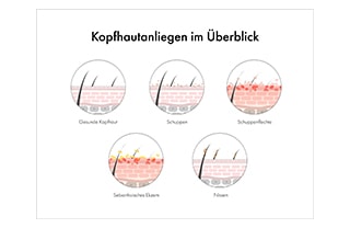 Infografik zu Kopfhauterkrankungen und Kopfhautproblemen mit Vergleich von gesunder Kopfhaut, Schuppen, Schuppenflechte, seborrhoischem Ekzem und Nissen