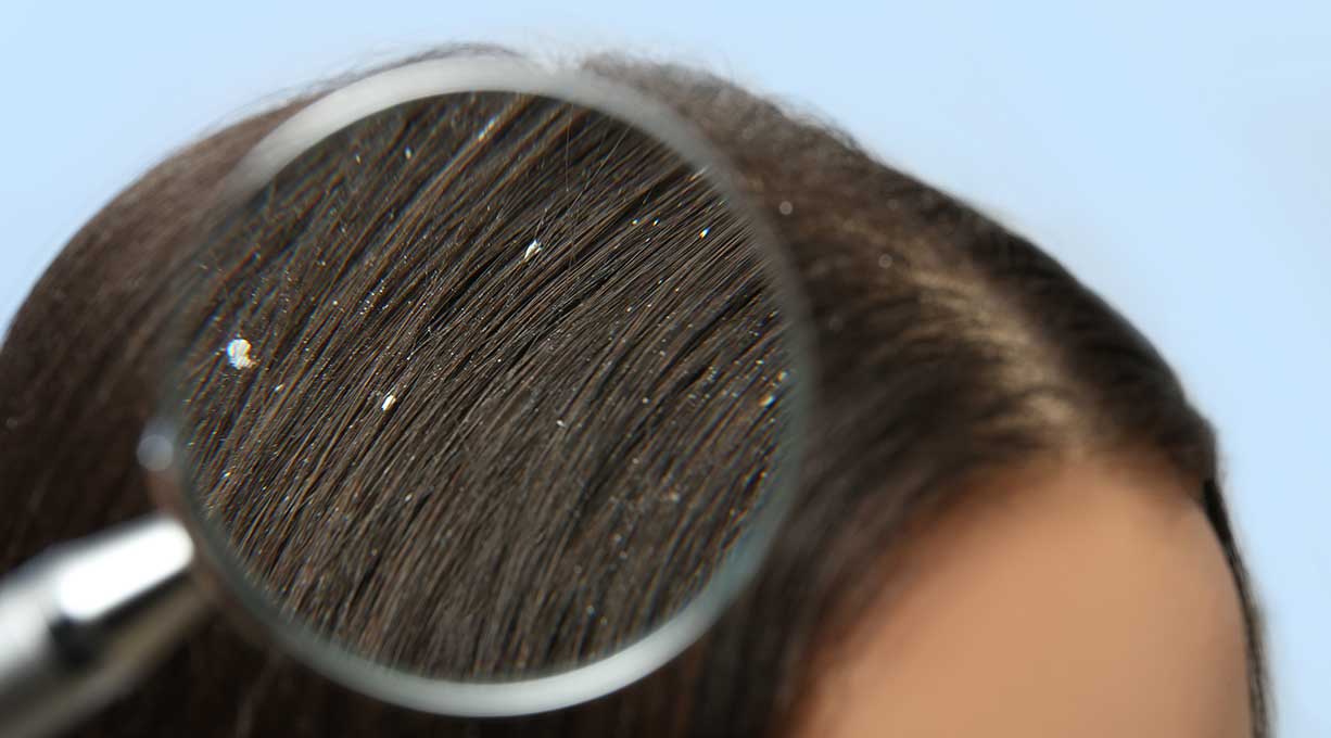 Haaransatz einer dunkelhaarigen Person mit weissen Schuppen durch eine Lupe