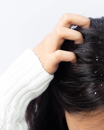 Femme aux cheveux foncés avec des écailles à la racine des cheveux