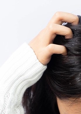 Frau mit dunklen Haaren und Schuppen am Haaransatz und sich dabei in die Haare greift