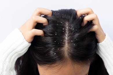 Frau mit dunklen Haaren und Schuppen am Haaransatz und sich dabei in die Haare greift