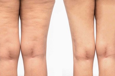 Definition_Cellulite