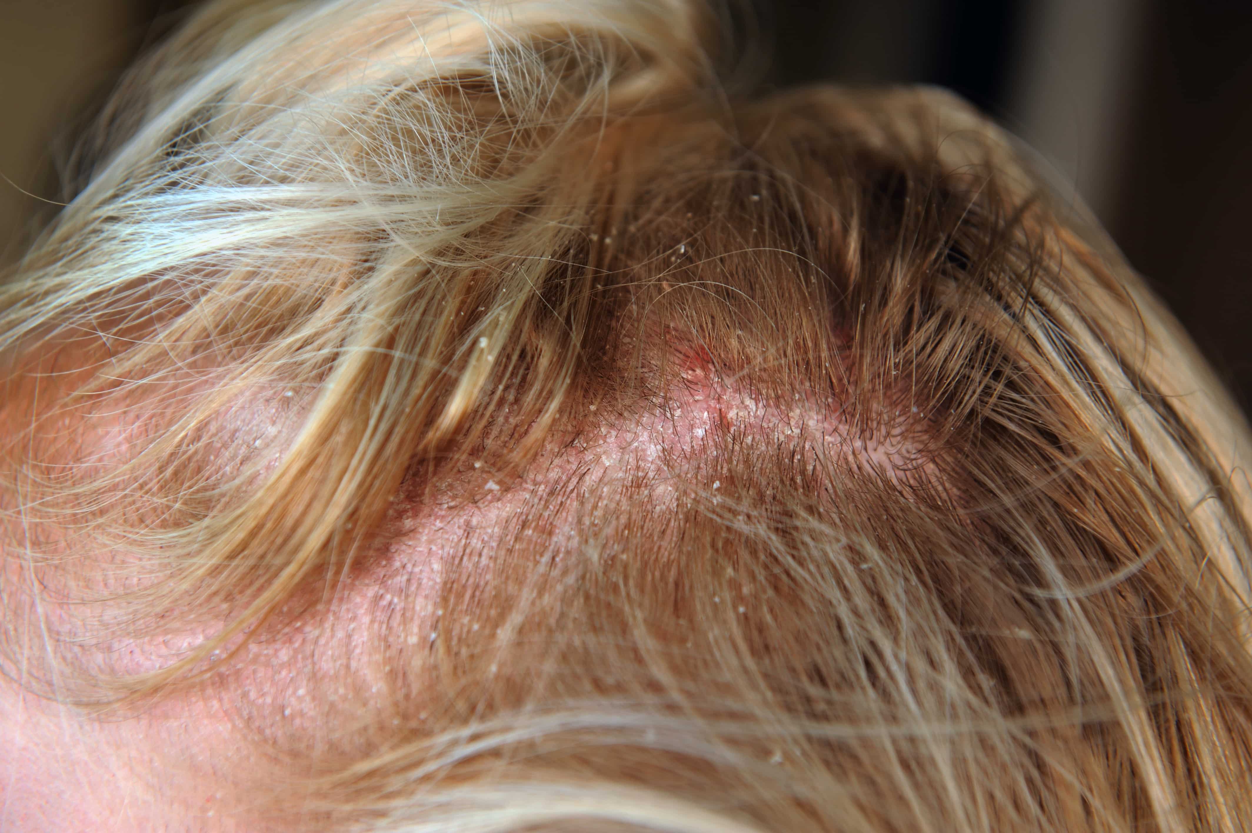 Gerötete, schuppige Kopfhaut am Haaransatz mit sichtbaren Hautirritationen wie von einem Sonnenbrand