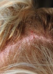 Gerötete, schuppige Kopfhaut am Haaransatz mit sichtbaren Hautirritationen wie von einem Sonnenbrand