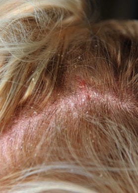 Gerötete, schuppige Kopfhaut am Haaransatz mit sichtbaren Hautirritationen wie von einem Sonnenbrand