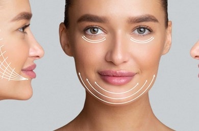 Gros plan d'une femme de face et de profil, avec des flèches dessinées sur les visages indiquant la direction dans laquelle l'effet lifting doit s'exercer.