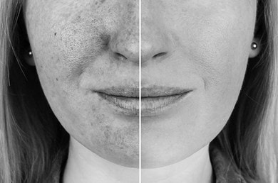 Auswirkung von UV(A) Strahlen auf die Haut im direkten Vergleich nebeneinander. Links UV-geschädigte Haut und rechts UV-geschützte Haut