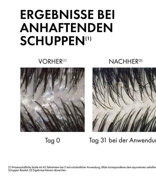 In einer Nahaufnahme der Kopfhaut werden die Ergebnisse des Shampoos bei anhaftenden Schuppen gezeigt. Nach 31 Tagen der Anwendung ist die Kopfhaut im Vergleich zu vorher von anhaftenden Schuppen befreit (Wissenschaftliche Studie mit 45 Teilnehmern bei 3 mal wöchentlicher Anwendung. Bilder korrespondieren dem äquivalenten anhaftenden Schuppen Resultat. Ergebnisse können abweichen).