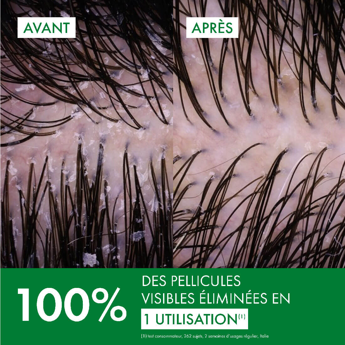 Avant-après du cuir chevelu: nettement moins de pellicules visibles après utilisation; indication de 100 % éliminées.