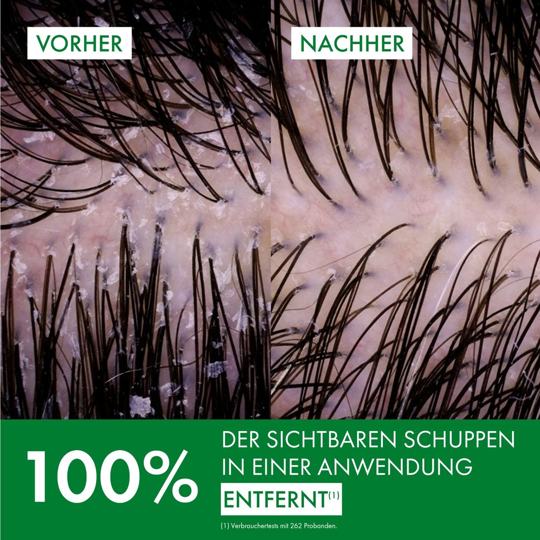Vorher-Nachher-Vergleich der Kopfhaut: 100 % der sichtbaren Schuppen nach einer Anwendung entfernt.